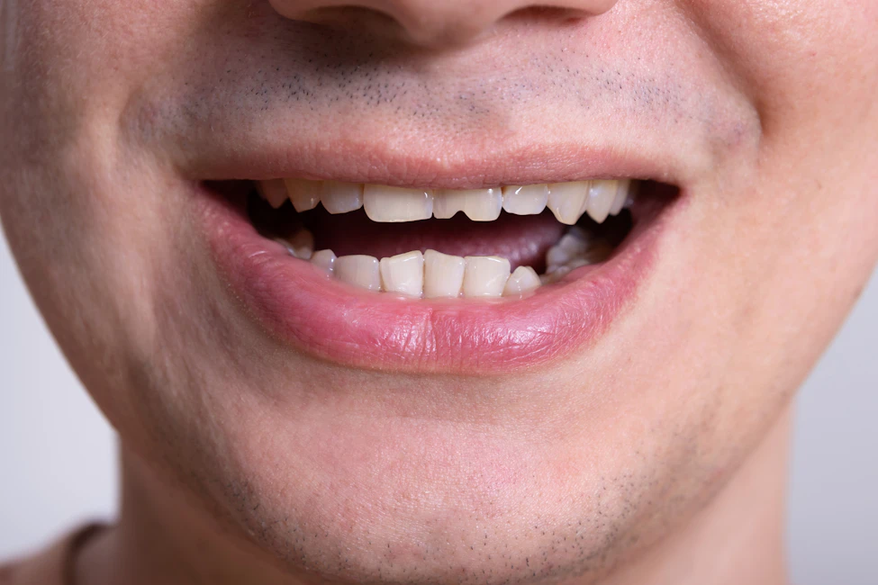 man with chipped front tooth