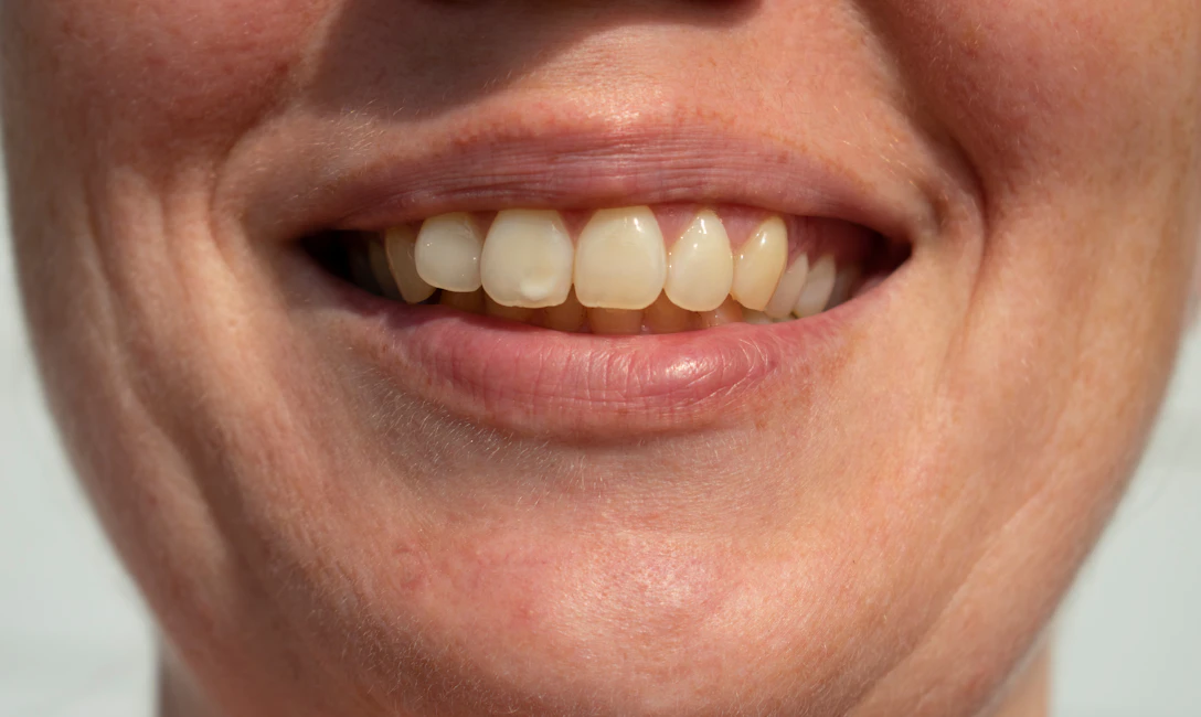 woman with white spot on front tooth