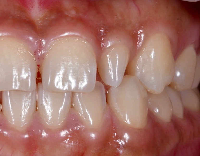 abnormally small tooth