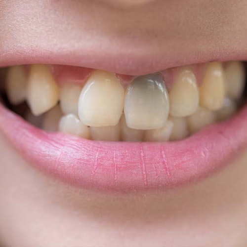 Discolored teeth