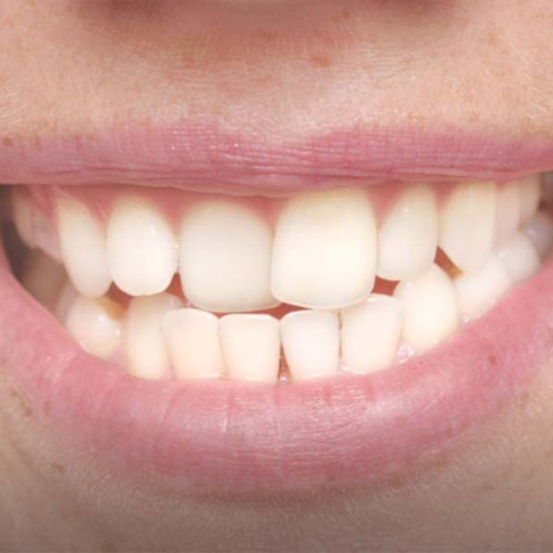 Crooked teeth