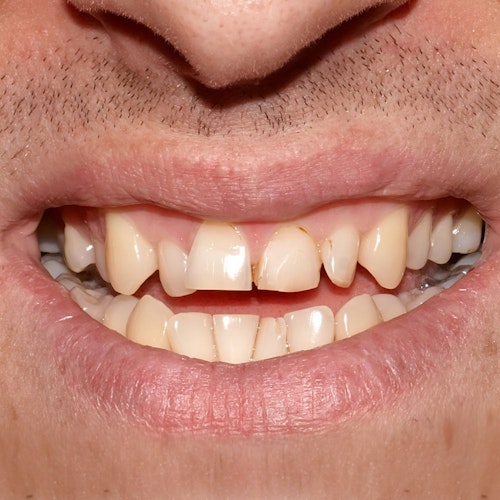 Misshaped teeth