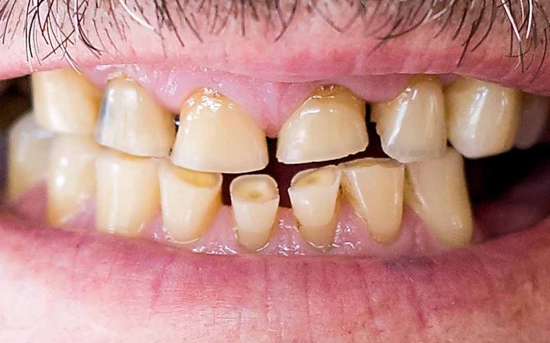 Eroded teeth