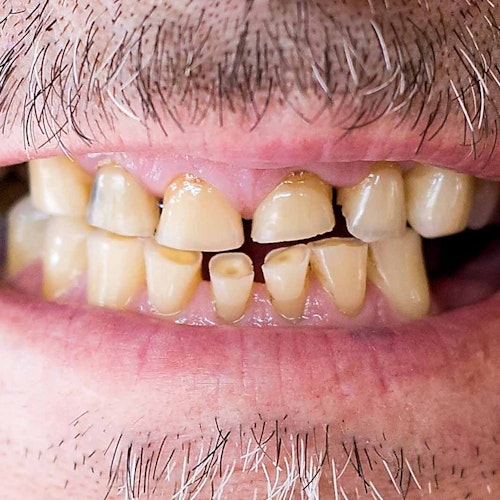 Eroded teeth