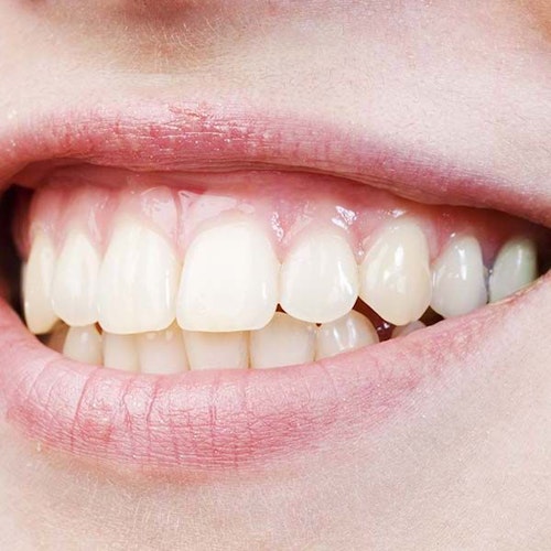 A gummy smile