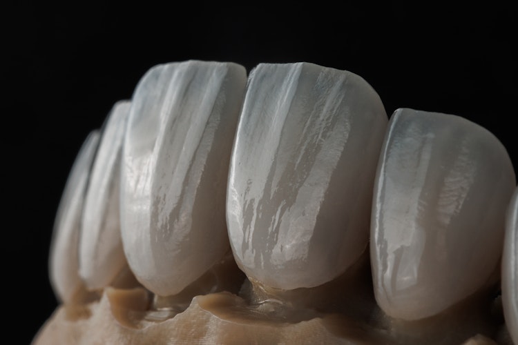 Veneers over teeth