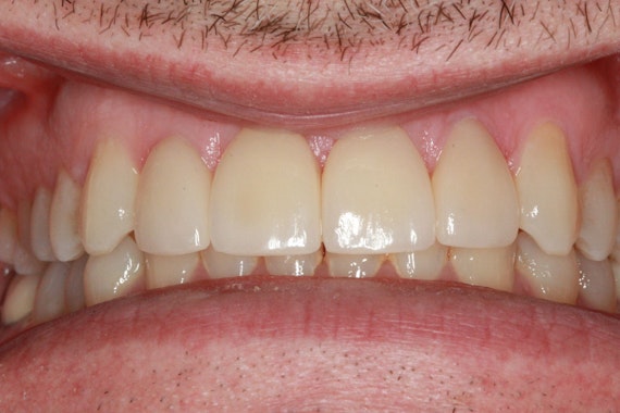 After veneers