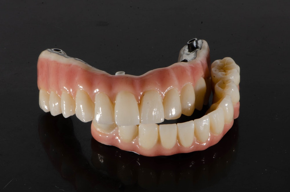 implant-supported dentures