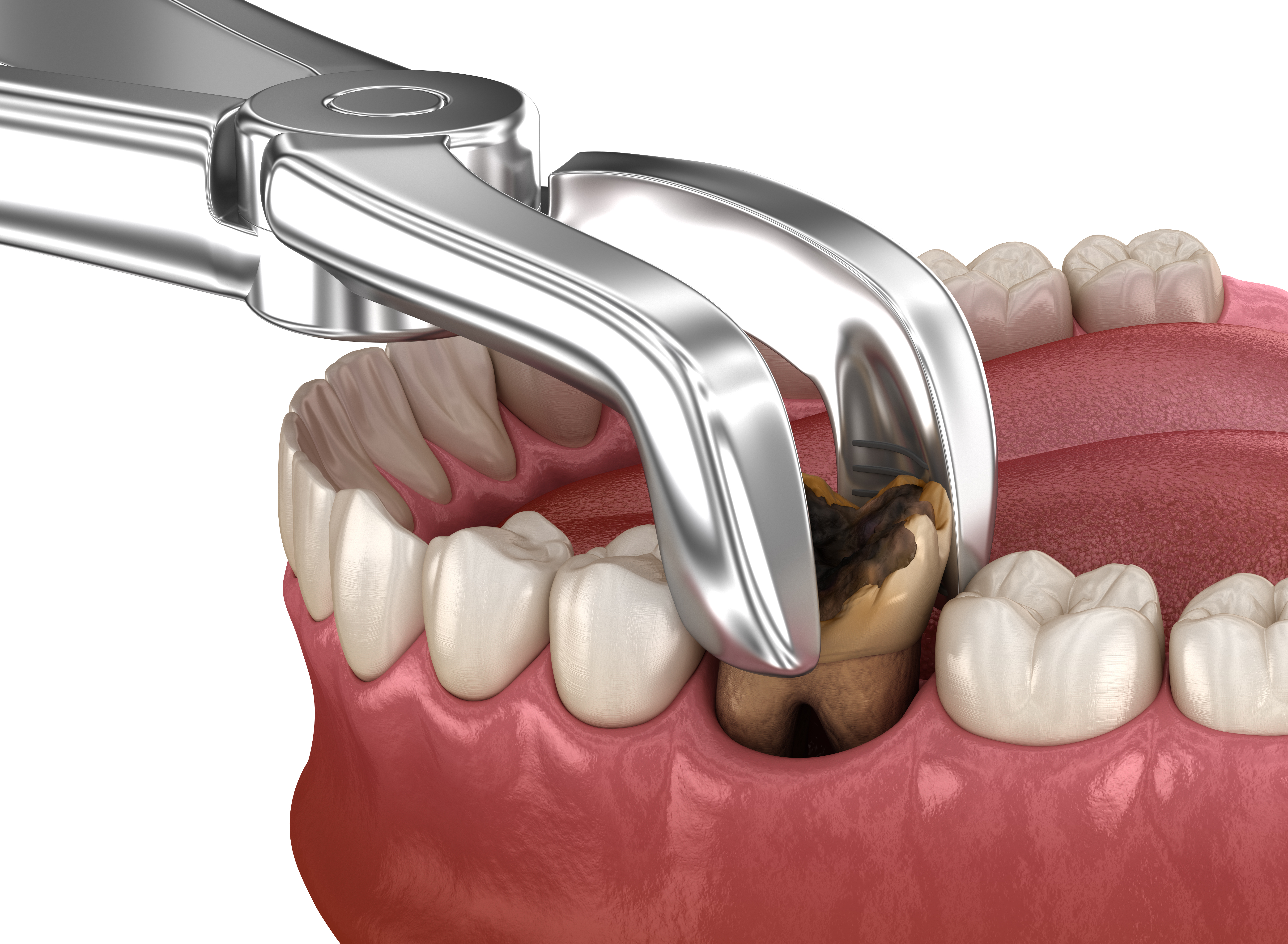 Tooth extraction illustration