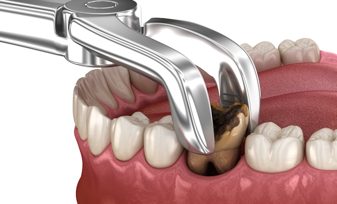 Tooth extraction illustration
