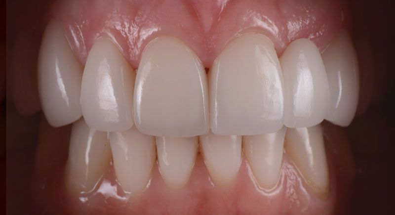 after dental implants