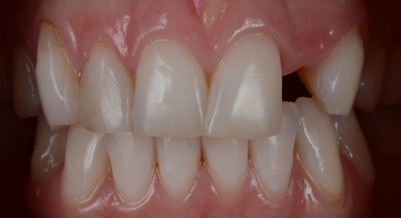 before dental implants