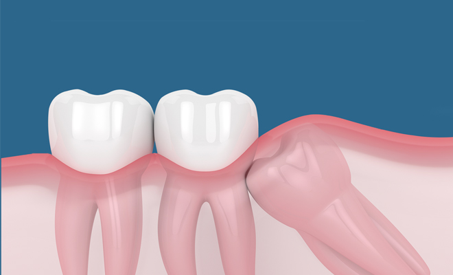 a 3d render of impacted impact teeth