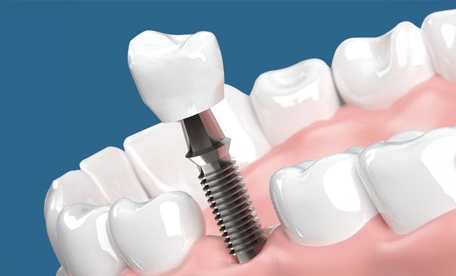 Dental implant being embedded in the jaw