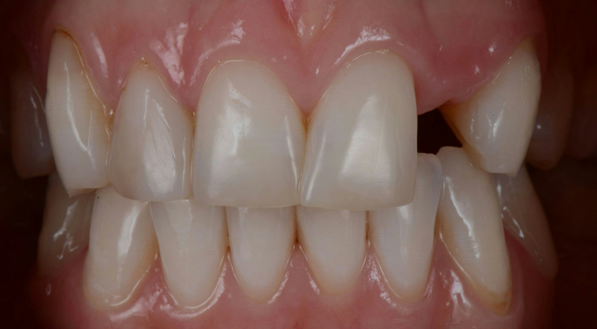 Before dental bridge procedure