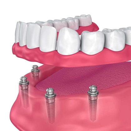 Implant denture