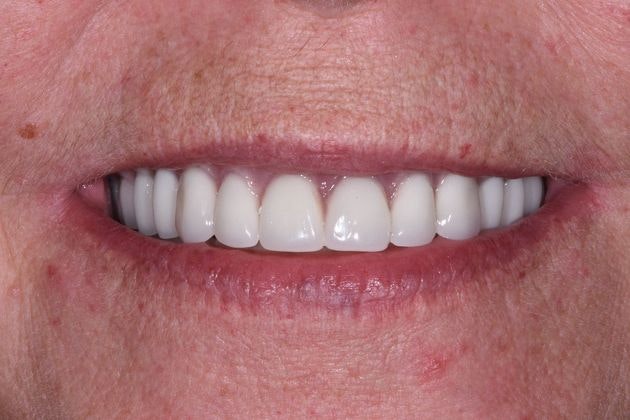 After dental treatment