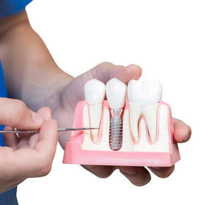 Dental implant model