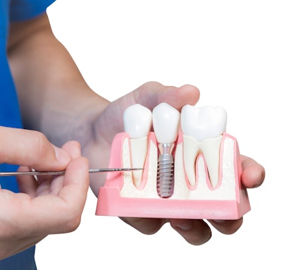 Dental implant model