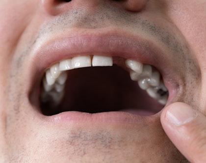 Man with missing and damaged teeth