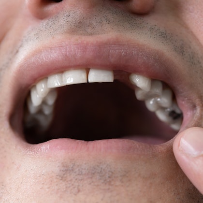 Man with missing and damaged teeth