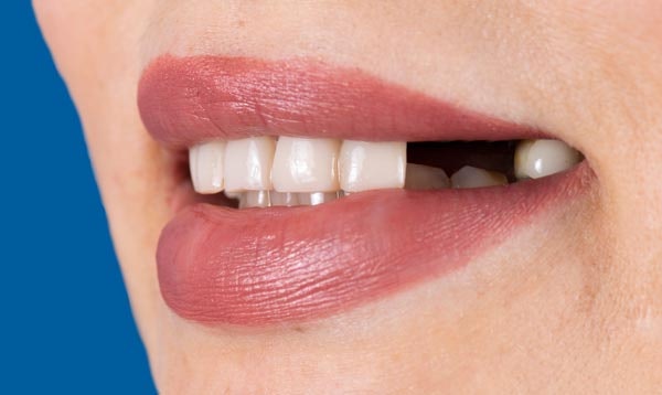 Before dental crowns