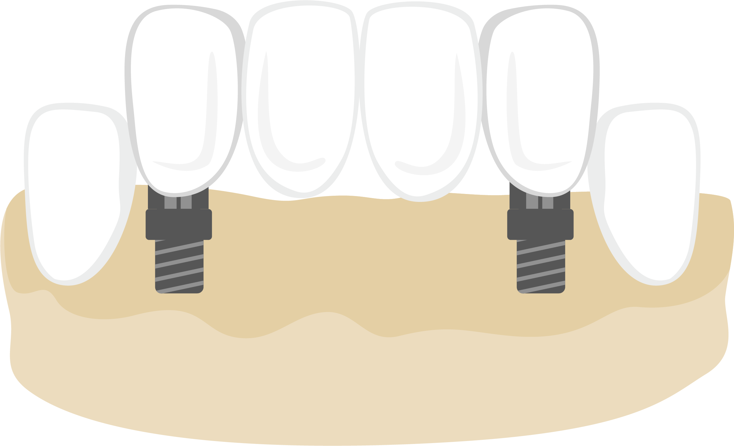 Illustration of an implant-supported bridge