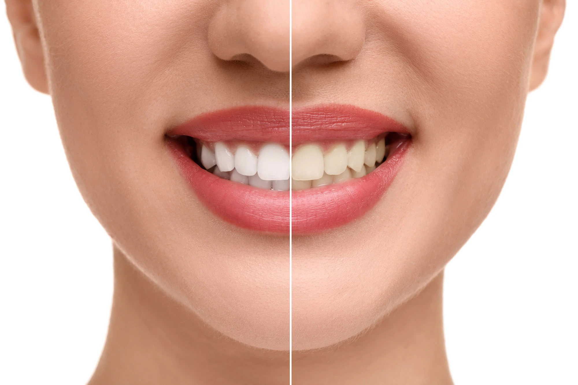 before after teeth whitening
