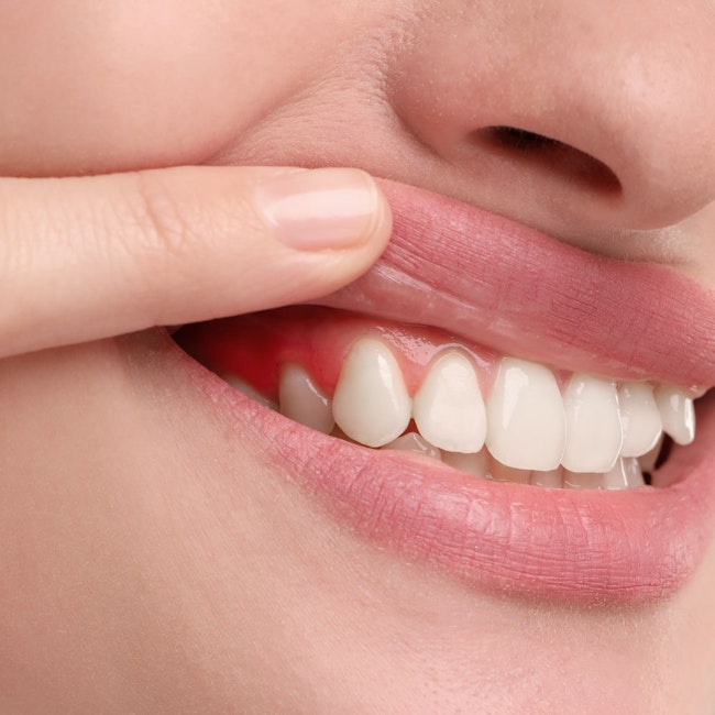 close up of gum inflammation