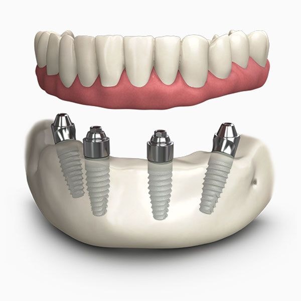 Model of the TeethXpress system