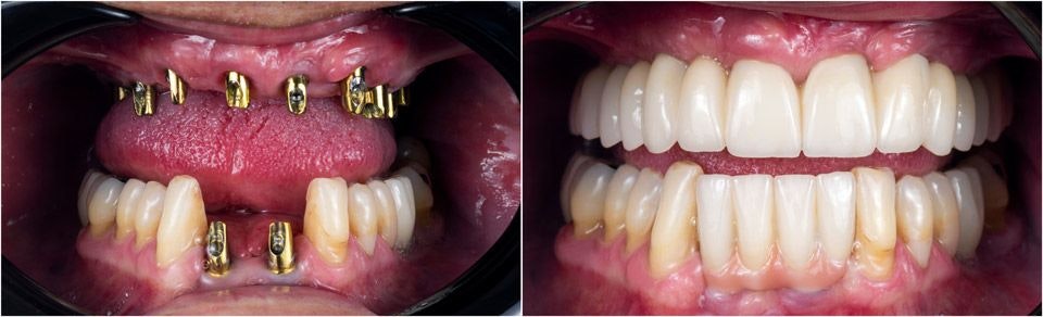 Before and after dental implants