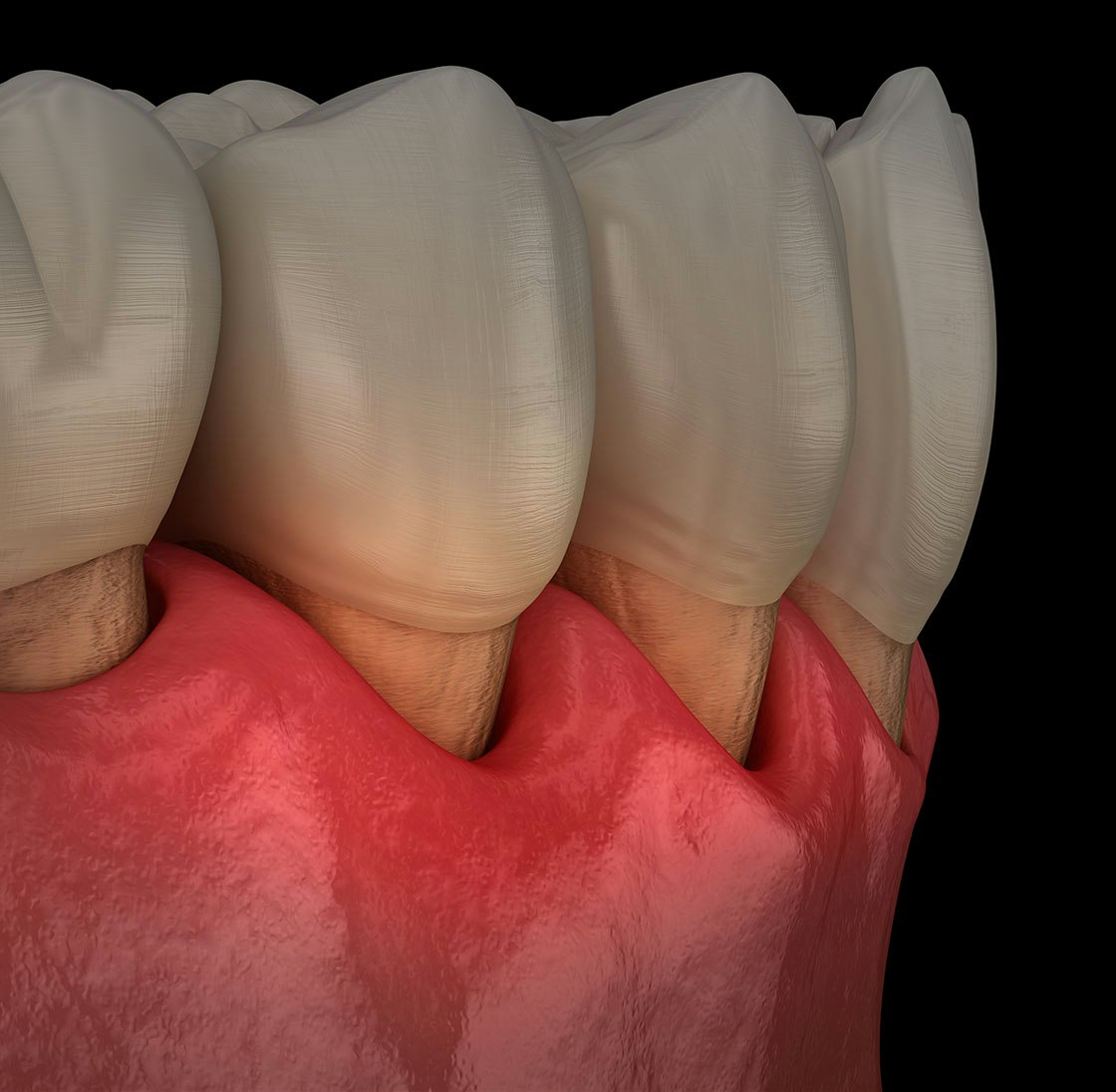 3d image showcasing gum recession