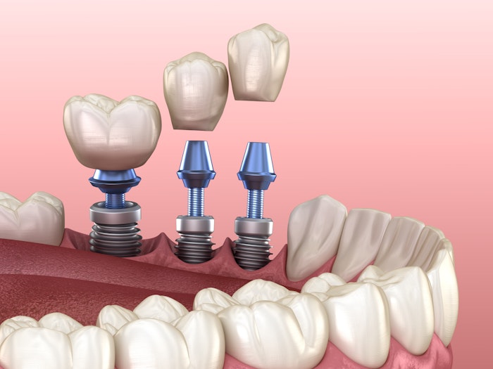 dental implants