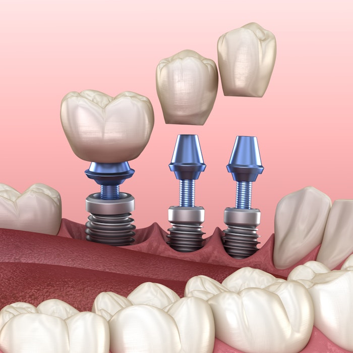 dental implants