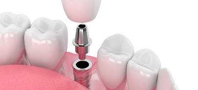 Dental Implants