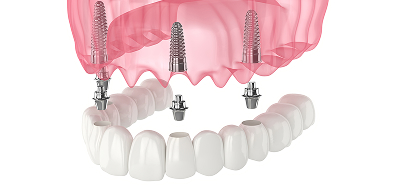 All-on-4® Dental Implants