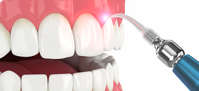 LANAP Laser Gum Therapy