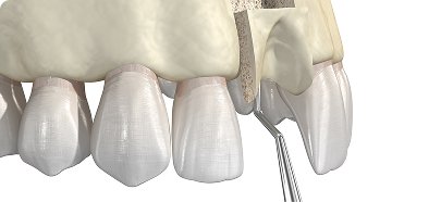 Bone Grafting