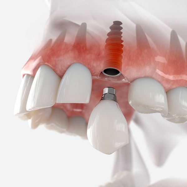 Dental Implants 3-D Model