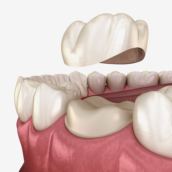 Dental Crowns 3-D Model