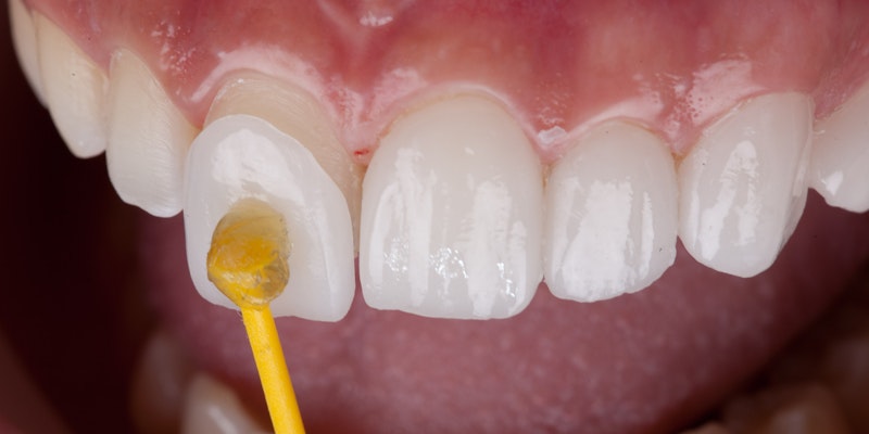 dental veneers