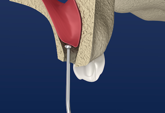 Sinus lift