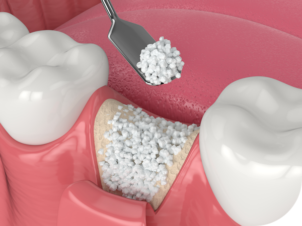 Illustration of implant being placed