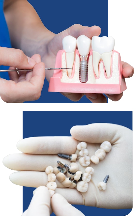 dentist showing a model of a dental implant