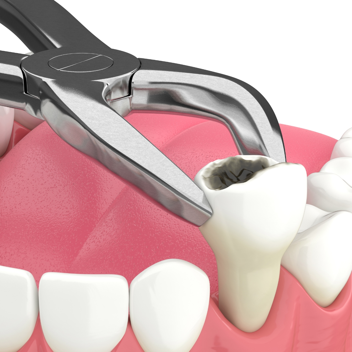 A 3D render of a tooth extraction
