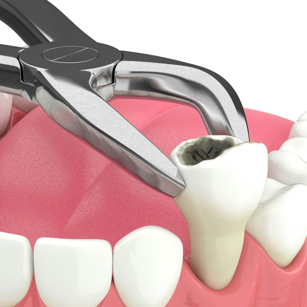 A 3D render of a tooth extraction