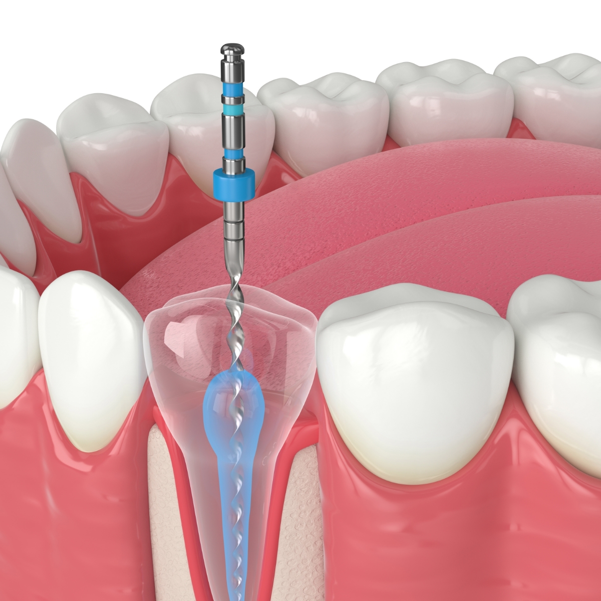 A 3D render of a root canal procedure