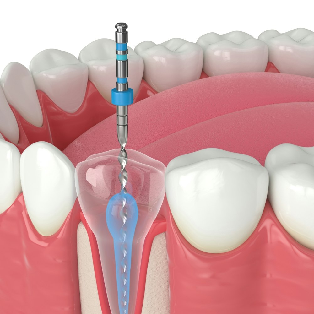 A 3D render of a root canal procedure