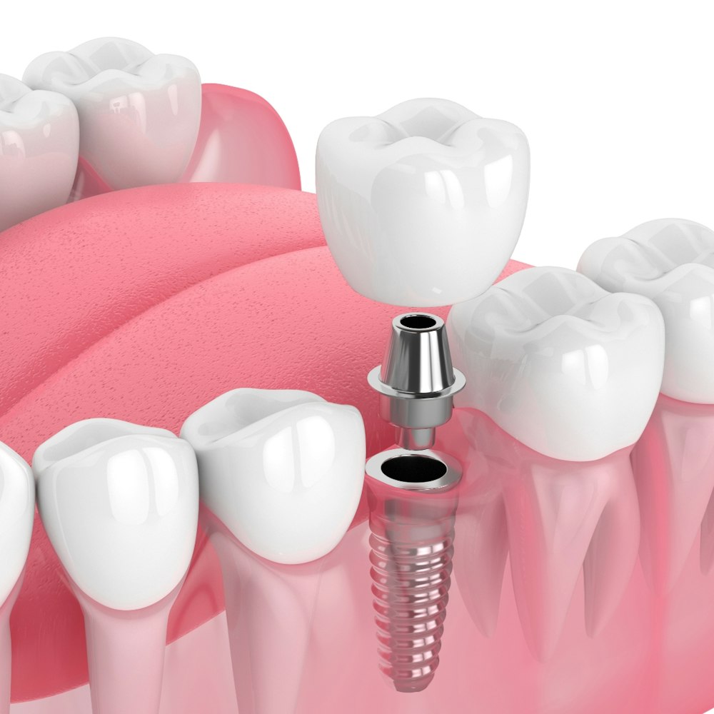 A 3D render of a dental implant procedure
