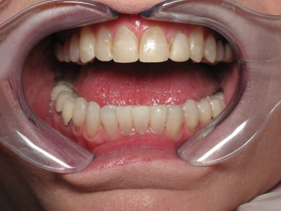 Dr. Wilkie's patient before veneers